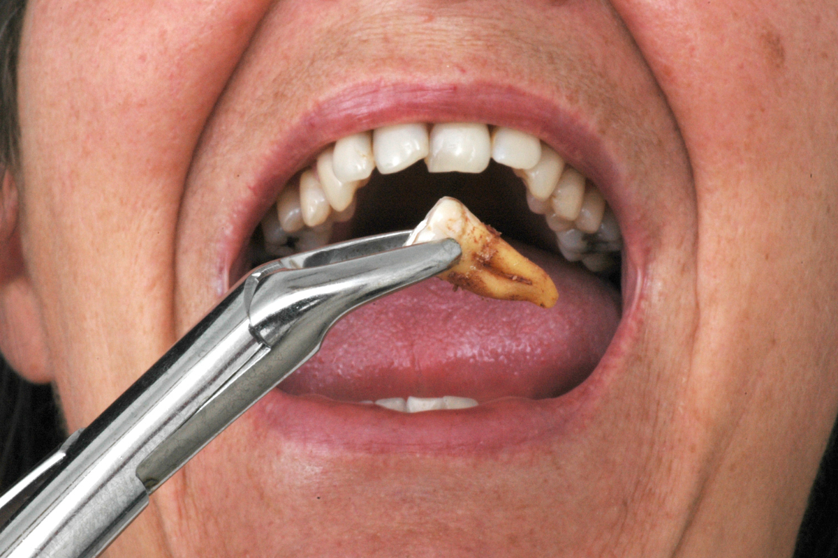 When Can You Eat Regular Food After Wisdom Tooth Extraction?