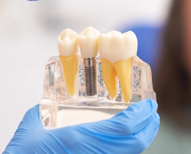 Dental professional holds model displaying natural tooth, implant, and crown restorations.