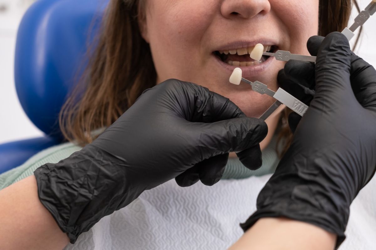 Are Veneers Worth It