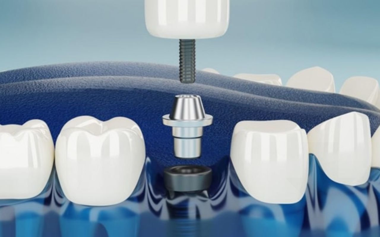 Do Dental Implants Hurt