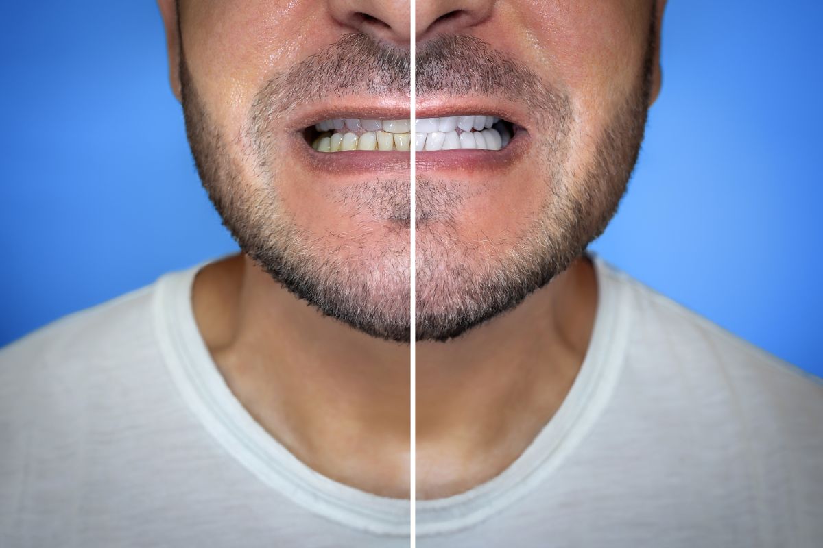 how-long-does-teeth-whitening-last-newport-beach