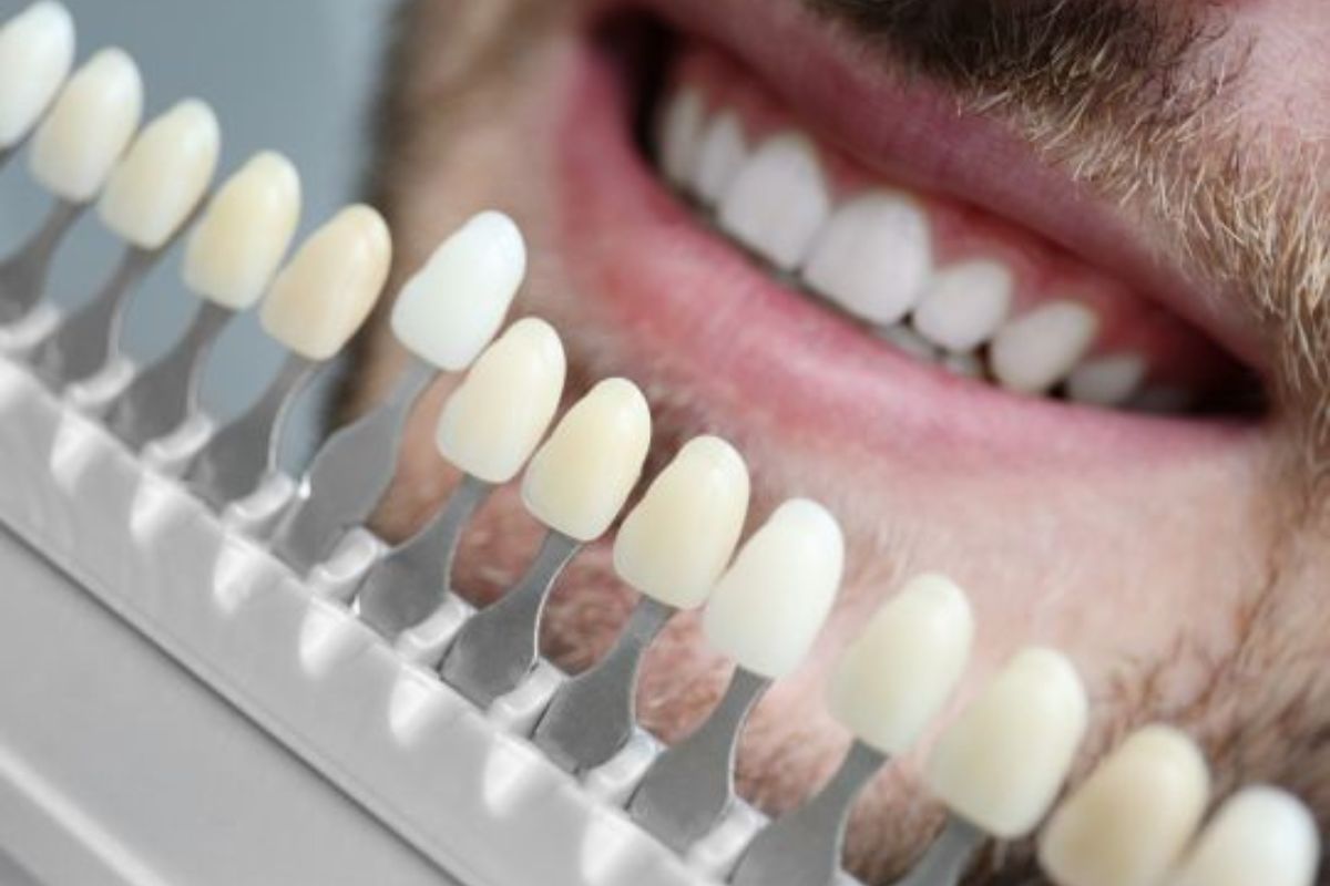 Do Porcelain Veneers Damage Natural Teeth