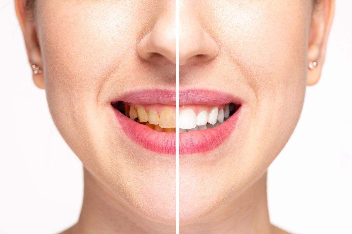 Reasons February Is the Perfect Month for Teeth Whitening