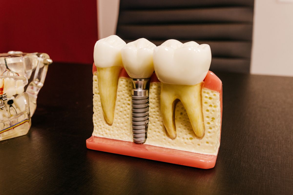 Dental Implant Surgery
