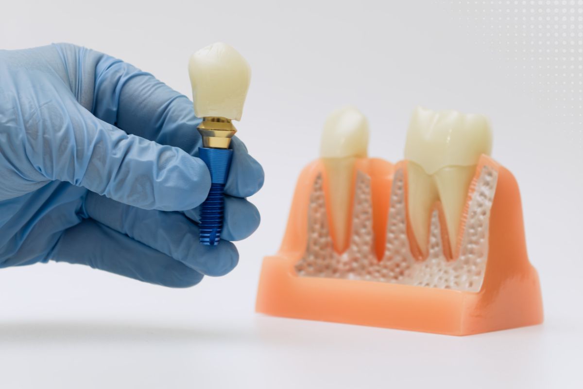 How Bone Loss Affects Dental Implant Success