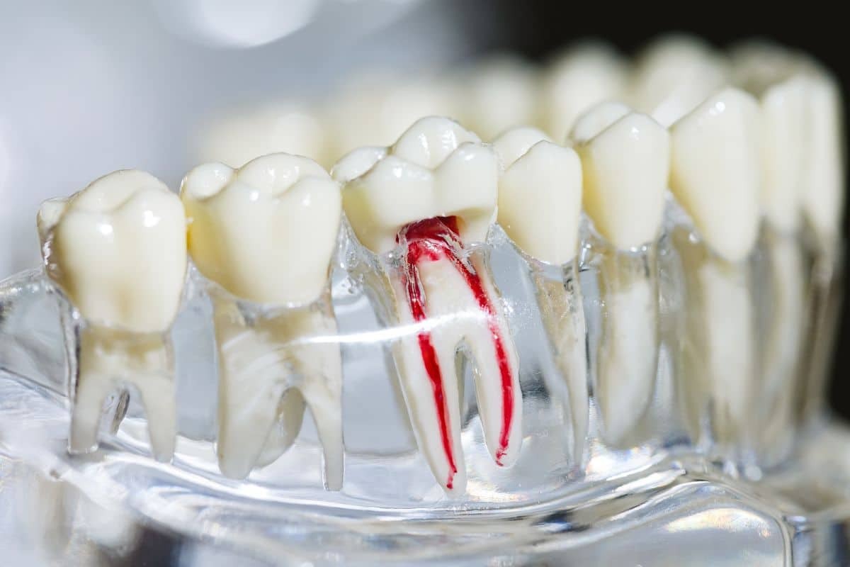 Tooth model showing inflamed pulp and blood vessels demonstrating root canal anatomy and endodontic treatment.